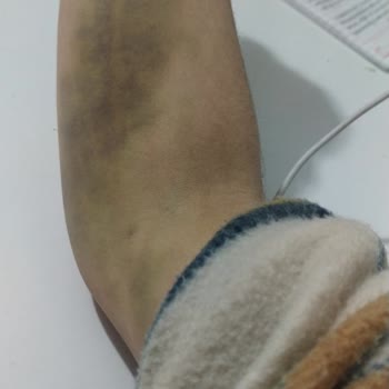 Zekai Tahir Burak Kadın Sağlığı Eğitim Ve Araştırma Hastanesi Kan Aldılar Kolum Morardı