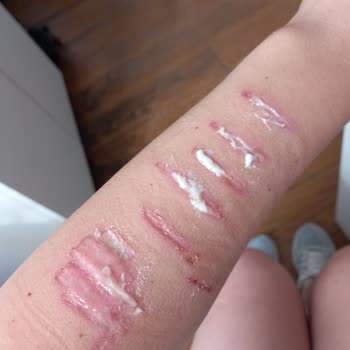 Özel Ekol International Tıp Merkezi Fraksiyonel Lazer Mağduriyeti