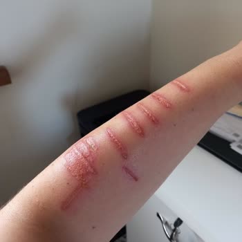 Özel Ekol International Tıp Merkezi Fraksiyonel Lazer Mağduriyeti