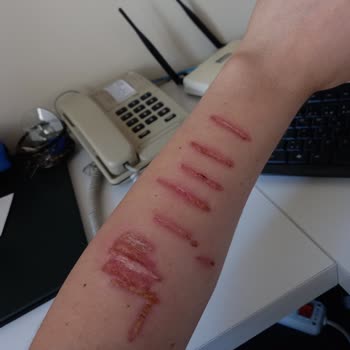 Özel Ekol International Tıp Merkezi Fraksiyonel Lazer Mağduriyeti