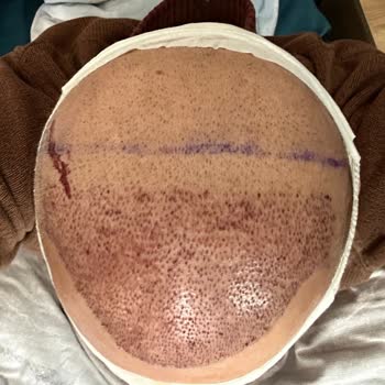 Forest Klinik Kafalarına Göre Saç Ekimi Yapmışlar