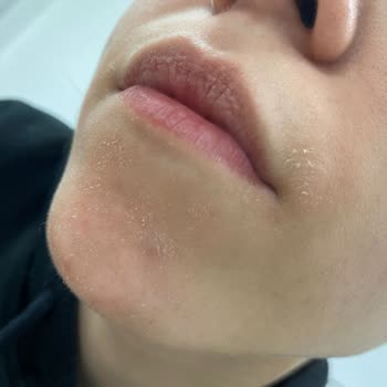 Garnier C Facial Cleansing Gel Ruined My Face!