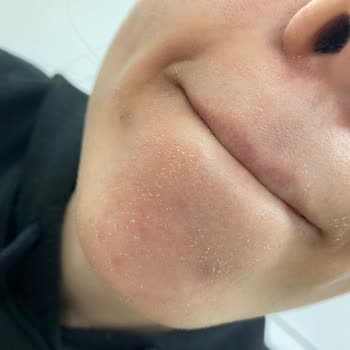 Garnier C Facial Cleansing Gel Ruined My Face!