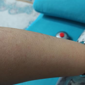 Neoslim Zayıflama ve Güzellik White Rose Lazer Kaynaklı Müşteri Memnuniyetsizliği