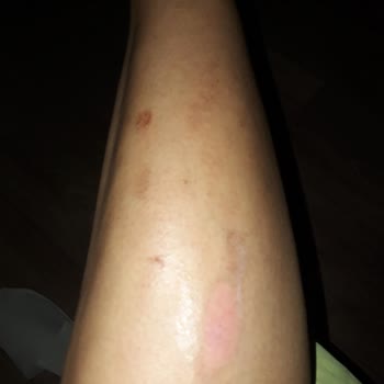 Dicle Sancar Beauty Center (siverek)&nbsp;lazer Epilasyon Yanığı