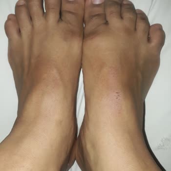 Dicle Sancar Beauty Center (siverek)&nbsp;lazer Epilasyon Yanığı