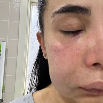 İstanbul Diş Hekimleri Odası İmplant Tedavisi Sırasında Sağlam Dişi Kırdılar