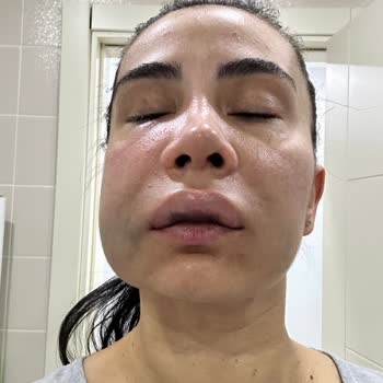 İstanbul Diş Hekimleri Odası İmplant Tedavisi Sırasında Sağlam Dişi Kırdılar