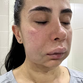 İstanbul Diş Hekimleri Odası İmplant Tedavisi Sırasında Sağlam Dişi Kırdılar