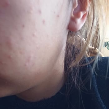 Cream Co Nemlendirici Sivilce Yaptı