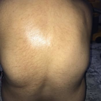 Parla Beauty Studio Hatalı İşlem Sonrası Cilt Çatlakları