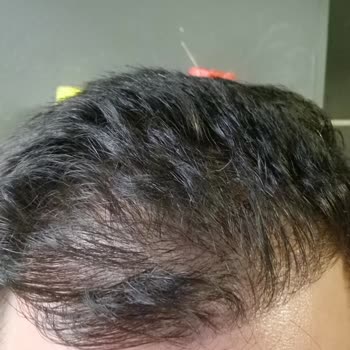 Million Hair Center Sadece Paranızı Alana Kadar Size İlgi Gösterecekler