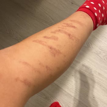 Sevlife Güzellik Merkezi Sevlife Güzellik Geçmeyen Lazer Yanığı