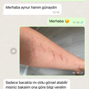 Sevlife Güzellik Merkezi Sevlife Güzellik Geçmeyen Lazer Yanığı