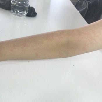 Zeina Beauty Kadıköy Lazer Epilasyon Mağduriyeti