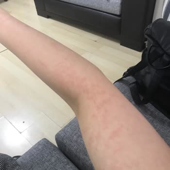 Zeina Beauty Kadıköy Lazer Epilasyon Mağduriyeti