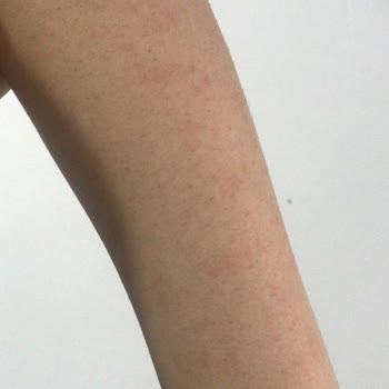 Zeina Beauty Kadıköy Lazer Epilasyon Mağduriyeti