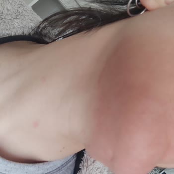 Loreal Paris Retinol Kullanım Sonucu Kızarıklık Tahriş