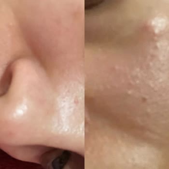 Yves Rocher Alerji Sivilce Yapan Kapalı Kutu Ürünün İade Değişim Sorunu