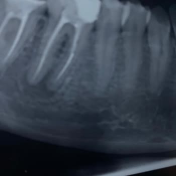 Yeni Yüzyıl Üniversitesi Diş Hekimliği Fakültesi Hastanesi Yapılan İhmal Sonucu Dişimin Çekileceği!