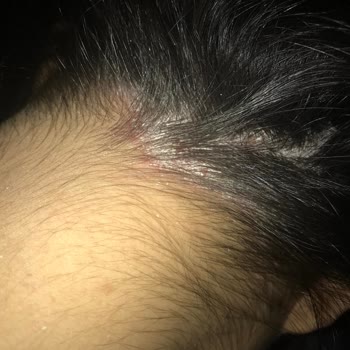 W-LAB Cosmetics Egzama Sorunum Baş Edilmez Hale Geldi