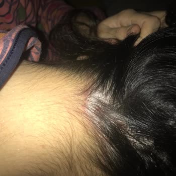 W-LAB Cosmetics Egzama Sorunum Baş Edilmez Hale Geldi