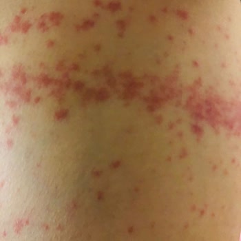 Abdi İbrahim Factive İlacı Yan Etkisi Hayatımı Mahvetti!