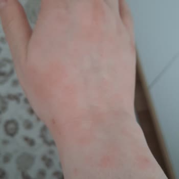 Abdi İbrahim Factive İlacı Yan Etkisi Hayatımı Mahvetti!