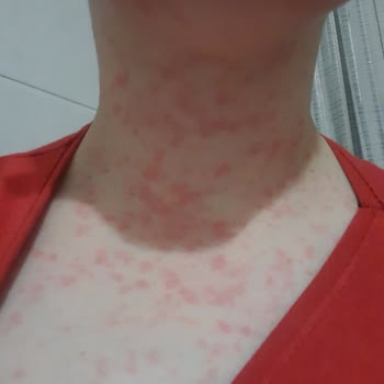 Abdi İbrahim Factive İlacı Yan Etkisi Hayatımı Mahvetti!