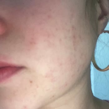 Yves Rocher Sensitive Camomille Kremin Alerji Yapması