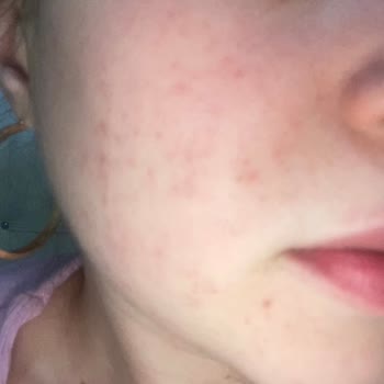 Yves Rocher Sensitive Camomille Kremin Alerji Yapması