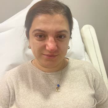 Op. Dr. Cengizhan Ekizceli Burun Estetiği Ameliyatı