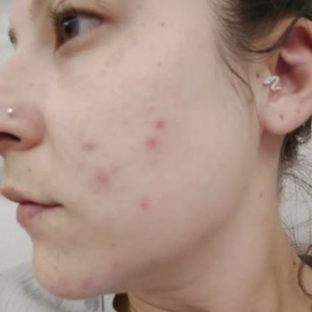 Dermoskin Arbutin+Tonik Faciası. Fena Derecede Sivilcelerim Oluştu.