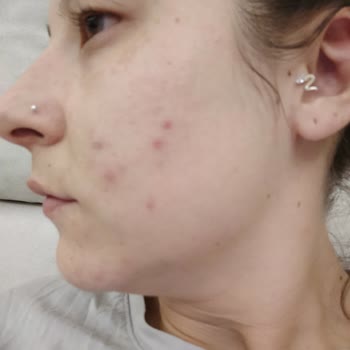 Dermoskin Arbutin+Tonik Faciası. Fena Derecede Sivilcelerim Oluştu.