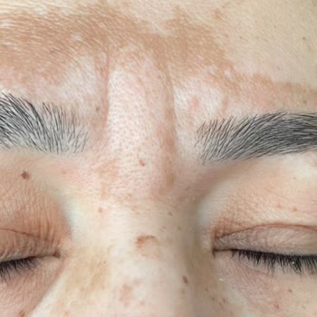 Mezoklinik Dermamelan Mağduriyeti Yaşıyorum