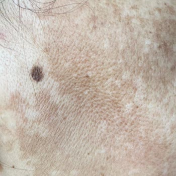 Mezoklinik Dermamelan Mağduriyeti Yaşıyorum