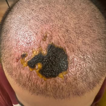 Medeks Hair Center Saç Ekimi Sonrası Nekroz Vakası