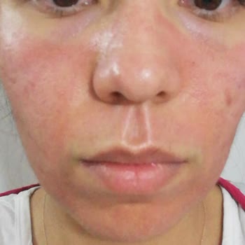 La Roche - Posay Effaclar Serum Yüzümü Yaktı