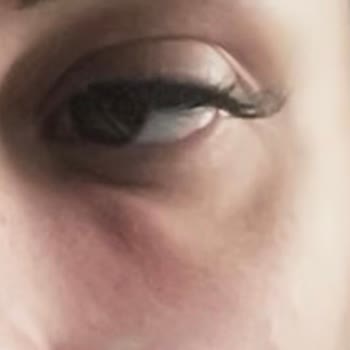 Estetik, Dolgu, Dr. Fatih Yıldız Dolgu, Dr. Fth Yıldız Dolgu