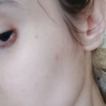 Celenes By Sweden Yüz Temizleme Jeli Sivilce Yaptı