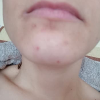 Celenes By Sweden Yüz Temizleme Jeli Sivilce Yaptı