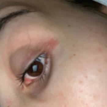 Caudalie Göz Kremi Yara Yaptı