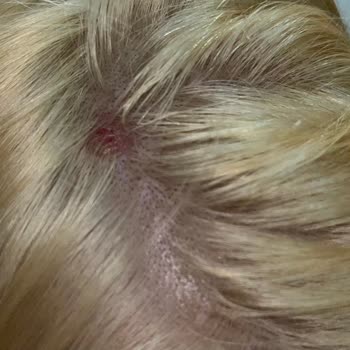 Palette Burned My Scalp And Made My Hair Fall Out