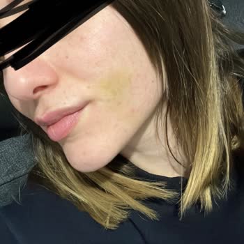 Dentacenter Röntgensiz Diş Çekimi Sıkıntısı !