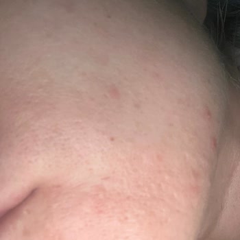 Missha Misha Serum Sivilce Yaptı