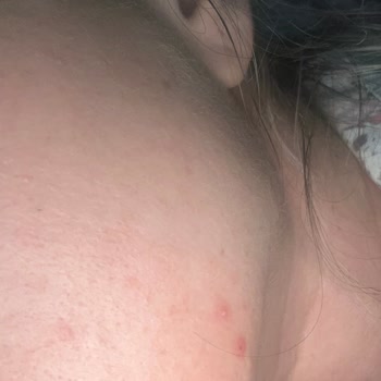 Missha Misha Serum Sivilce Yaptı