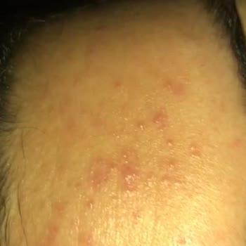 Gratis Beaulis Close It Kapatıcı Alerji Yaptı