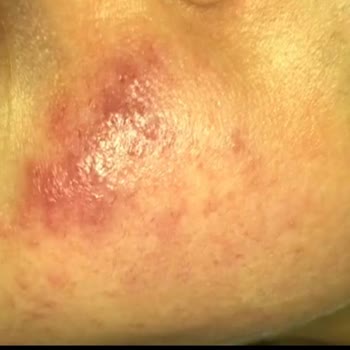 Gratis Beaulis Close It Kapatıcı Alerji Yaptı