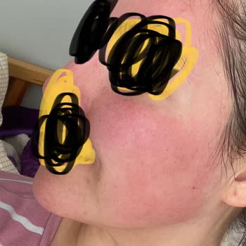 Claderm Yüz Maskesi Yüzümü Yaktı!