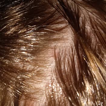 12/22 Palette Gümüş Gri Saç Boyası Saç Derisi Yaktı Ve Su Topladı!